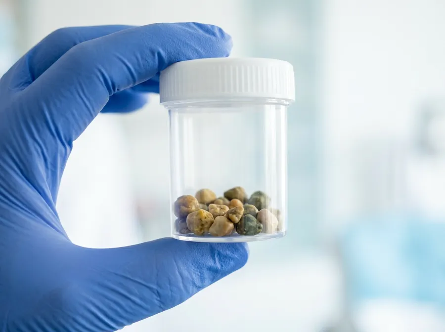 Gallstones removed during gallbladder surgery